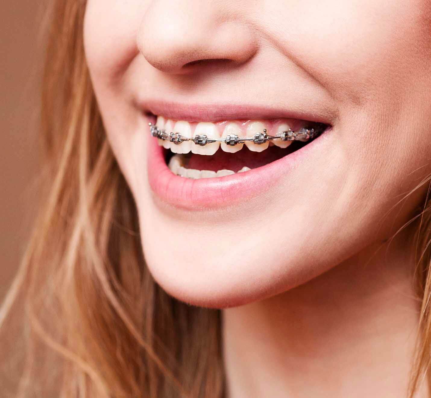 braces-banner-1
