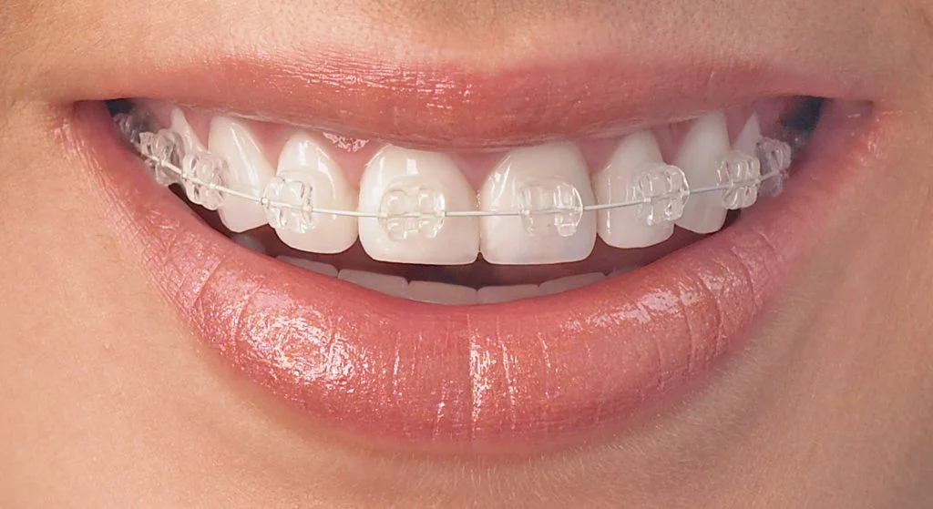 clear-ceramic-bracket-to-put-in-the-fixed-cosmetic-section-1024x559
