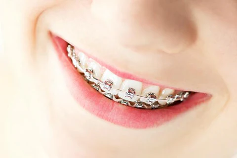 metal-braces2_grande_a1311087-0843-4990-b6d7-0478850f13e5_large