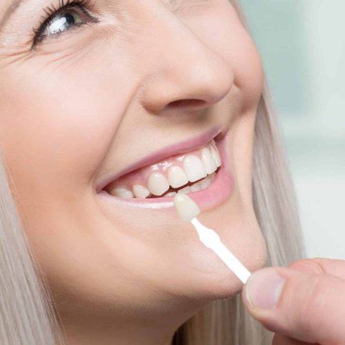 The-Different-Types-of-Veneers-2048x1365